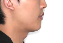 돌출입 케이스 치료 후 (AFTER)