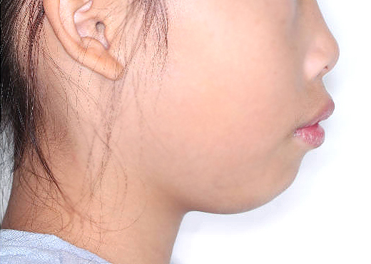 돌출입 케이스 치료 전 (BEFORE)