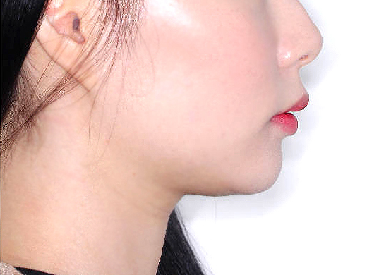 돌출입 케이스 치료 후 (AFTER)