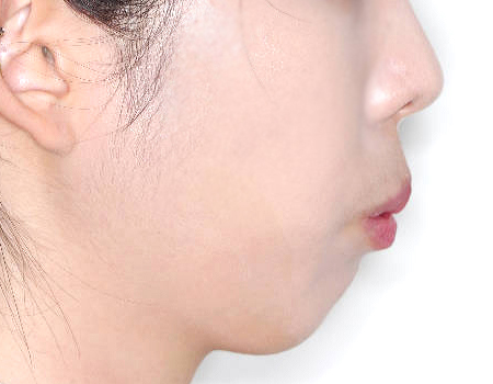 무턱 케이스 치료 전 (BEFORE)