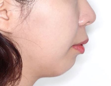 무턱 케이스 치료 전 (BEFORE)