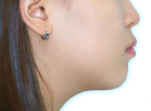 주걱턱 양악수술 병행 케이스 치료 후 (AFTER)