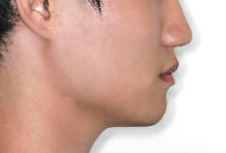 돌출입 케이스 치료 후 (AFTER)