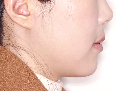 무턱 케이스 치료 후 (AFTER)