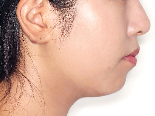 돌출입 케이스 치료 전 (BEFORE)