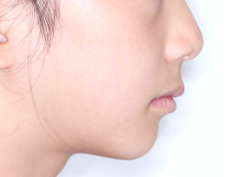 무턱 케이스 치료 전 (BEFORE)