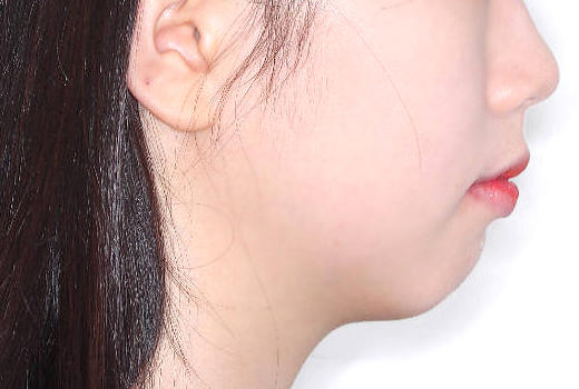 돌출입 케이스 치료 전 (BEFORE)