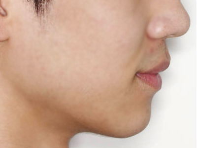 돌출입 케이스 치료 후 (AFTER)
