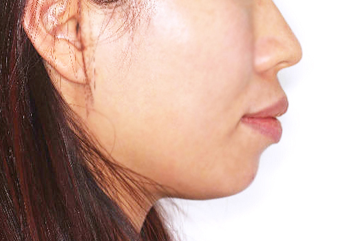 돌출입 케이스 치료 전 (BEFORE)