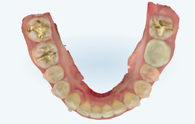 iTero 3D 스캐너