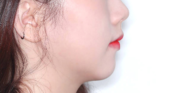 효과 애프터