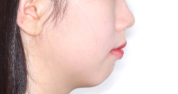 효과 비포
