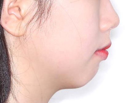 비포애프터1