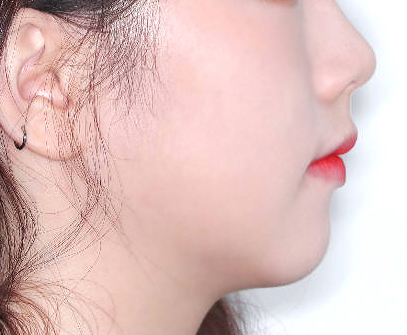 비포애프터2