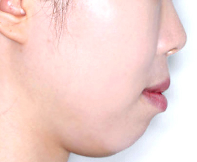 비포애프터3