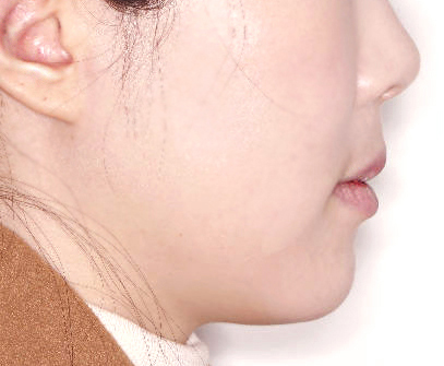 비포애프터4